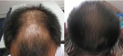 突然大量脱发是怎么回事啊?脱发厉害是什么原因呢?治疗脱发贵吗