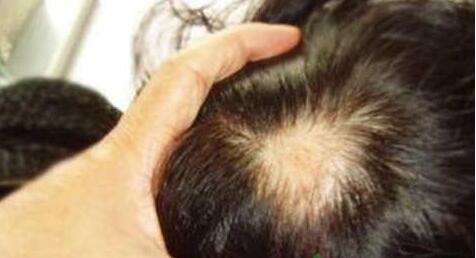 脂益性脱发能治愈好吗?怎么治疗?还会在长吗?脱发的症状治疗偏方