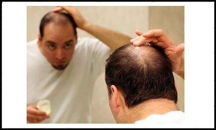 青年男女性头顶脱发落发怎么办?脱发的原因及治疗方法有哪些?