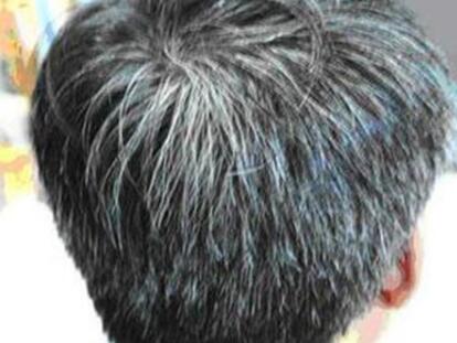 男人耳朵两边突然长很多白头发是什么原因造成的?