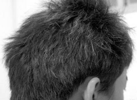 年轻人后脑勺为什么会长白头发?什么原因?怎么治疗?