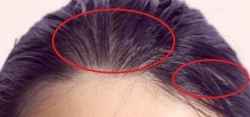 头发脂溢性皮炎是什么引起的?怎么办?如何根治?