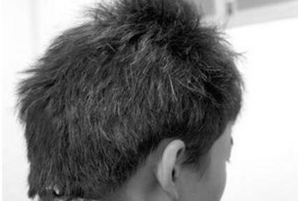 高中生两侧鬓角_耳朵两边头发突然变白是什么原因引起的?