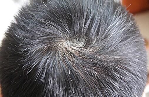 三十岁男生耳朵两侧白头发越来越多是什么原因引起的啊?