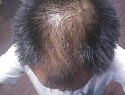 男性头顶头发漩涡处头发稀少的原因是什么?怎么办?