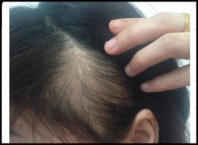 婴儿额头前面的头发越来越稀少怎么办?是什么原因导致的?