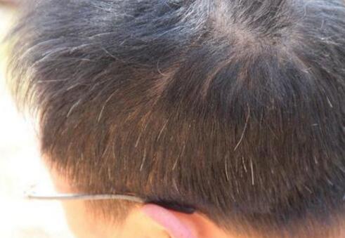 青少年额头头发越来越稀少的原因是什么?怎么办?