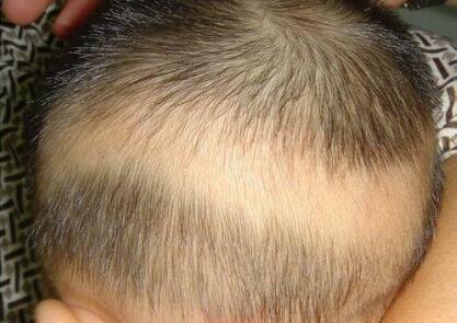 孩子后脑勺头皮上有一圈少了一块头发是怎么回事?怎么使头发变多?