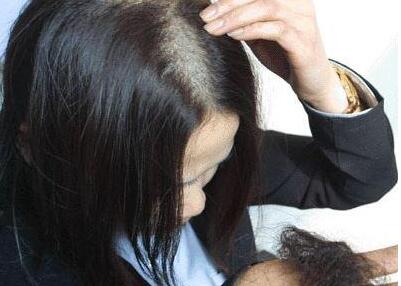 生完孩子头发变少了怎么办才好啊?怎样头发才能变多?