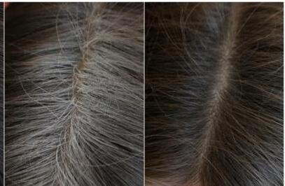 肾虚引起的头发早白能变黑吗?应该怎么治疗?吃什么可以改善?