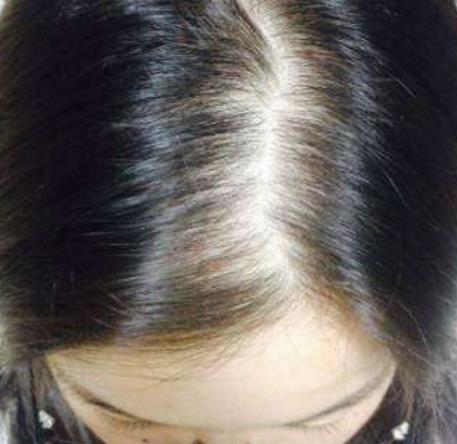 女性头顶头发稀少的原因是什么?怎么办?头发稀少补救的偏方_办法