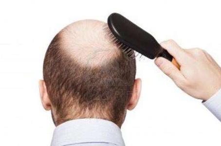 男人头顶头发稀少的原因是什么?是肾虚吗?怎么调理?
