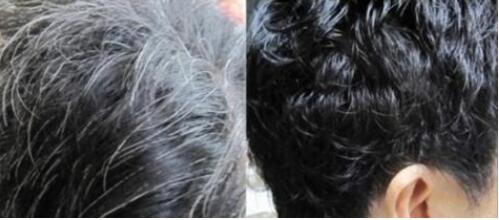年轻人刘海长白发是什么原因?怎么办?怎样可以让头发变多变黑色?