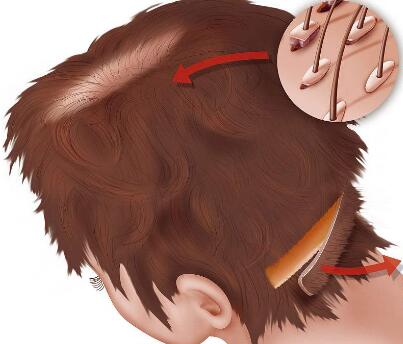 中年男士溢脂性皮炎引起的脱发该怎么办?吃什么防止脂溢性脱发?