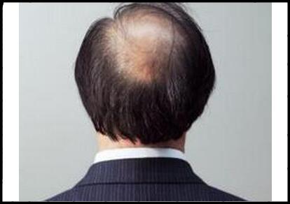 50岁男人头顶_前额为什么会脱发?怎么治疗?吃什么防止脱发?
