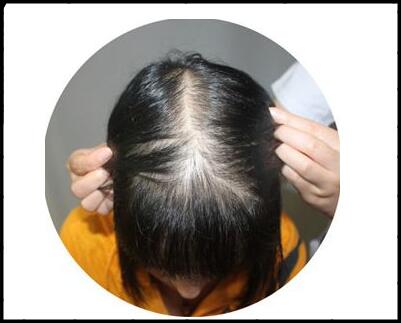 日本女士脱发严重什么原因引起的?怎么办呢?防脱发的洗发水排行榜