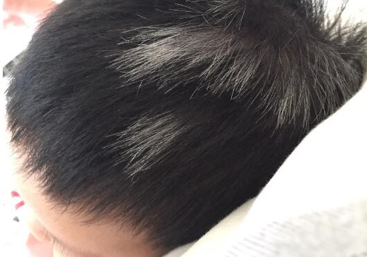 8个月婴儿额头上有一根白头发是怎么回事?什么原因引起的?怎么办?