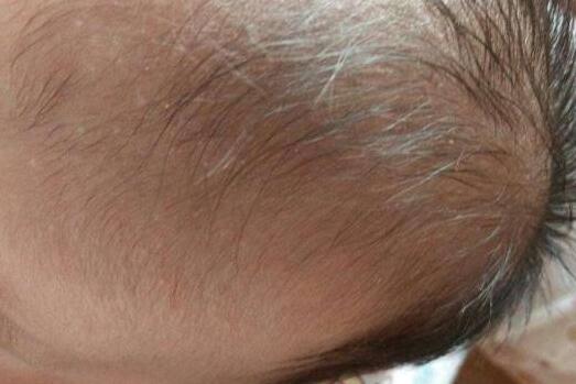 1岁半_3岁宝宝经常掉头发很厉害是什么原因引起的?正常吗?