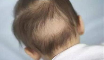 3个月_4岁宝宝后脑勺总是掉头发严重是怎么回事啊?怎么办啊?