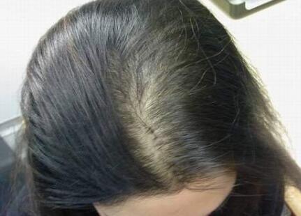 女生掉头发特别严重是什么原因引起的?怎么办?看医生挂什么科室?