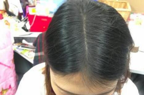20岁女生头发老是油还掉的很严重是什么原因引起的?怎么办啊?