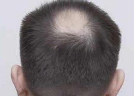 男人老是头发掉的厉害是什么原因引起的?怎么办?会是什么病?