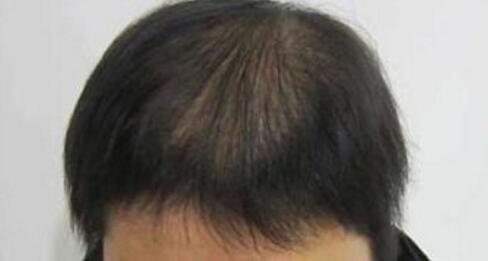 28_30多岁男人为什么头顶容易掉头发呢?是什么原因造成的?