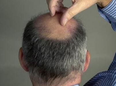 老人突然耳鸣_鬓角掉头发是什么原因引起的?怎么样可以防止掉发?