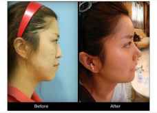 韩国鼻子美容 鼻尖 鼻孔 鼻头 鼻梁 鼻翼部整形术前后对比照片图