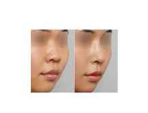 中国鼻部美容修复怎么样?韩式鼻子歪整形手术前后对比照图片大全
