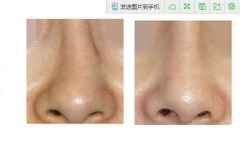 去韩国修复鼻子中隔弯曲 外伤 错位 疤痕 鼻孔外露得要多少钱一支